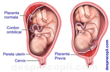 placenta previa