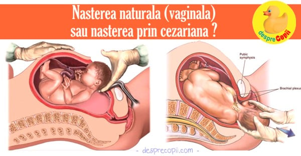 nastere naturala versus nastere cezariana