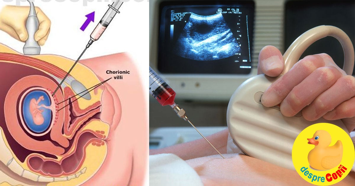 Testul de vilus corionic sau prelevarea de vilozitati coriale - cand si de ce se efectueaza in timpul sarcinii