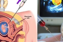 Testul de vilus corionic (prelevarea de vilozitati coriale): când și de ce se efectuează in timpul sarcinii