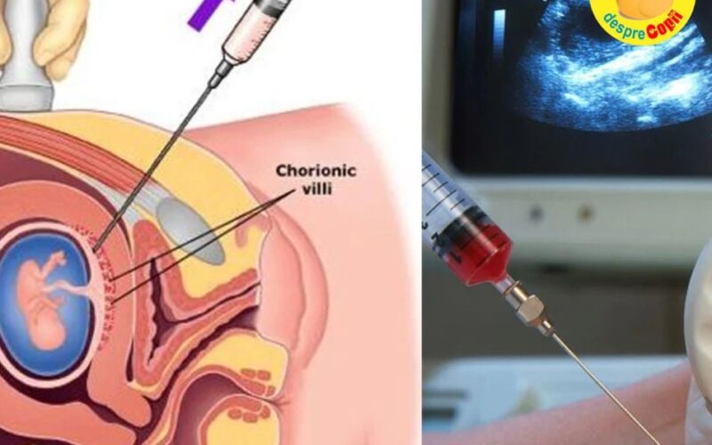 Testul de vilus corionic (prelevarea de vilozitati coriale): când și de ce se efectuează in timpul sarcinii