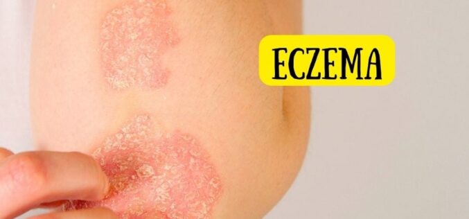 Cremele și produsele pentru bebeluși pot favoriza eczema – iată sfatul medicului dermatolog
