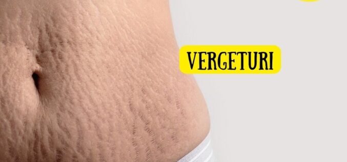Vergeturile sau tatuajele naturii care ne amintesc de calatoriile vietii  – tratamente și 3 lucruri pe care trebuie să le știi de la inceput