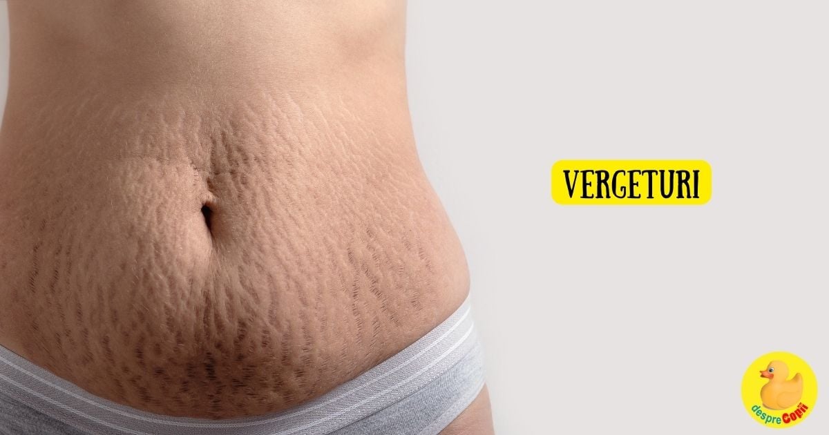 Vergeturile sau tatuajele naturii care ne amintesc de calatoriile vietii - tratamente si 3 lucruri pe care trebuie sa le stii de la inceput