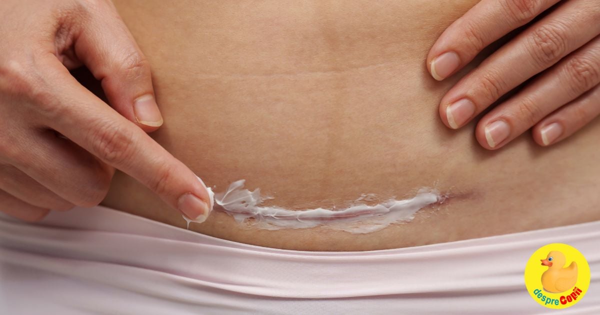 Recuperarea dupa cezariana. La 4 saptamani dupa operatie iata la ce sa te astepti
